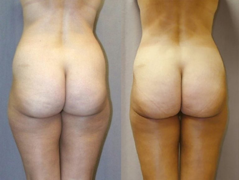 liposuction-hips-outer-and-inner-thighs back view