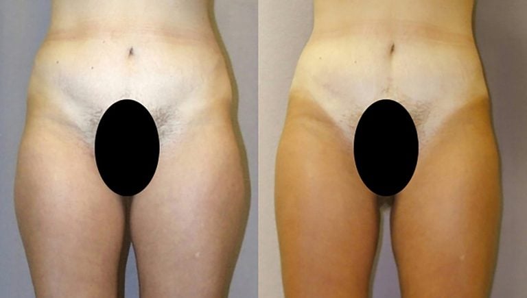 Liposuction-hips-outer-and-inner-thighs
