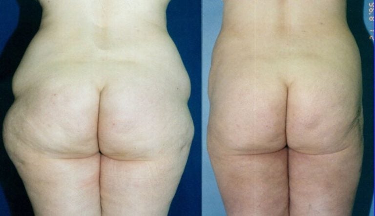 liposuction-hips-outer-thighs