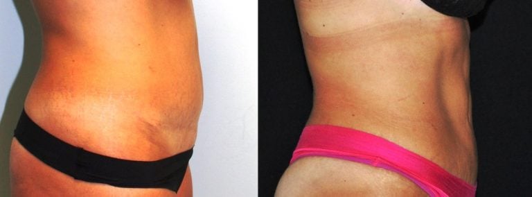 Liposuction Iliac Crests and Abdomen