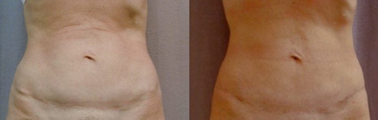 liposuction-tummy-after-abdominoplasty