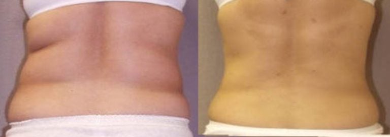 liposuction-tummy-and-flanks-back-view