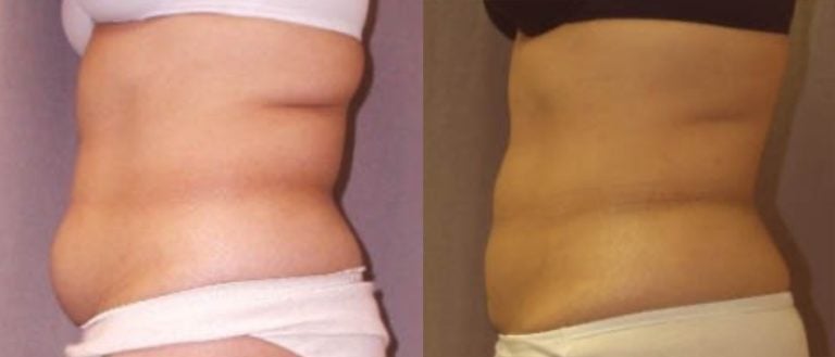 liposuction-tummy-and-flanks-side-2-view