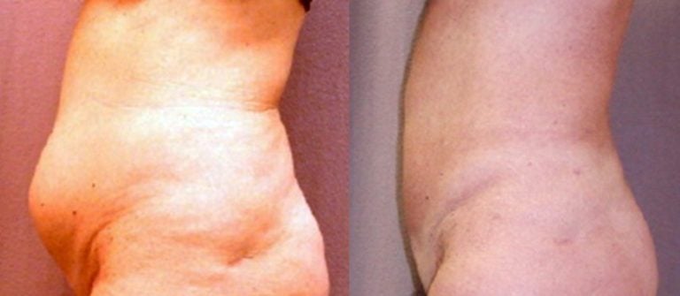 liposuction-tummy-and-hips