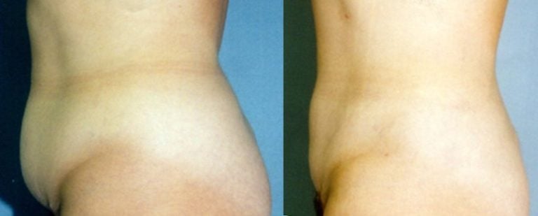liposuction-tummy-and-hips
