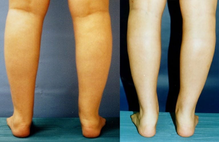 lower-leg-back