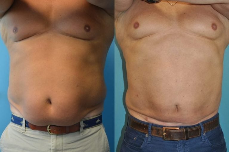 Male BodyTite 6 weeks after surgery front