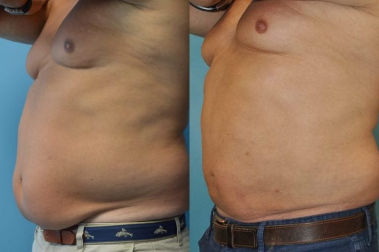 Male BodyTite 6 weeks after surgery oblique