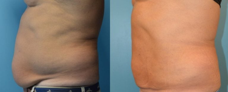 Male BodyTite and Liposuction 6 weeks after surgery left side view