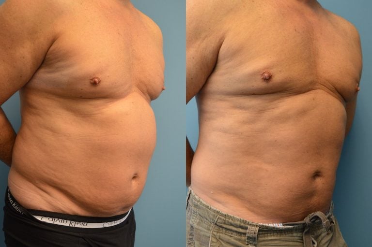 Male Bodytite and liposuction of abdomen right oblique view