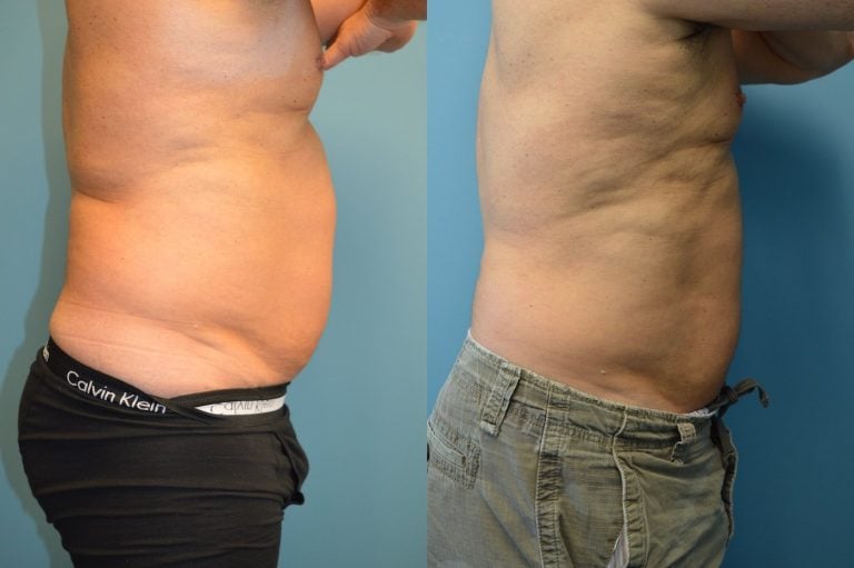 Male Bodytite and liposuction of abdomen side view