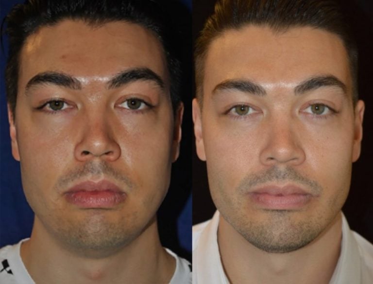 Buccal fat excision and square jaw implant
