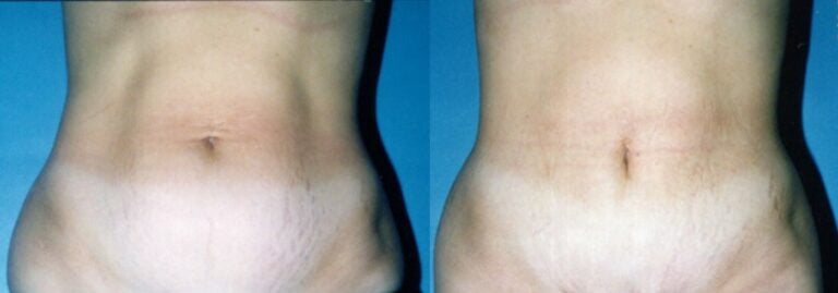 mini tummy tuck, short scar, skin and fat excision only lower abdomen