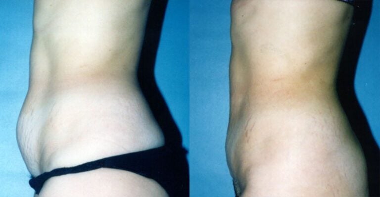 mini tummy tuck, short scar, skin and fat excision only lower abdomen, side