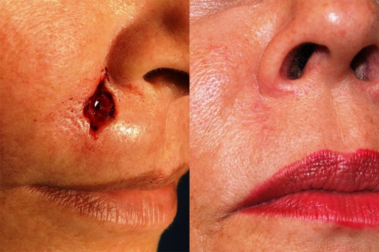 Mohs excision of skin cancer repair 8 weeks after surgery