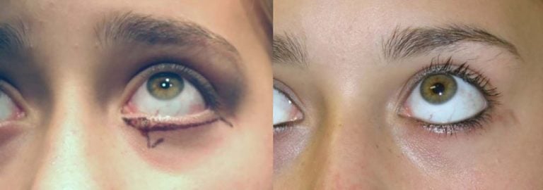 Mole excision lower eyelid with skin advancement