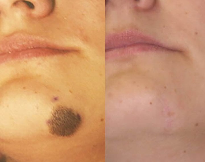 Mole left chin, staged serial excision