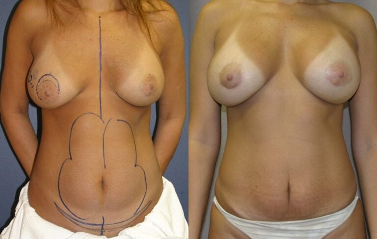 Mommy-Makeover.-Liposuction-abdomen-mini-tummy-tuck-with-breast-augmentation-one-year-front