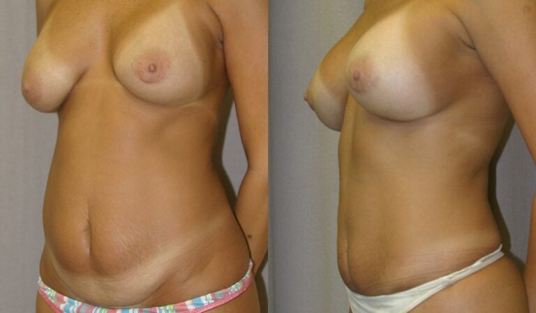 Mommy-Makeover.-Liposuction-abdomen-mini-tummy-tuck-with-breast-augmentation-one-year-oblique