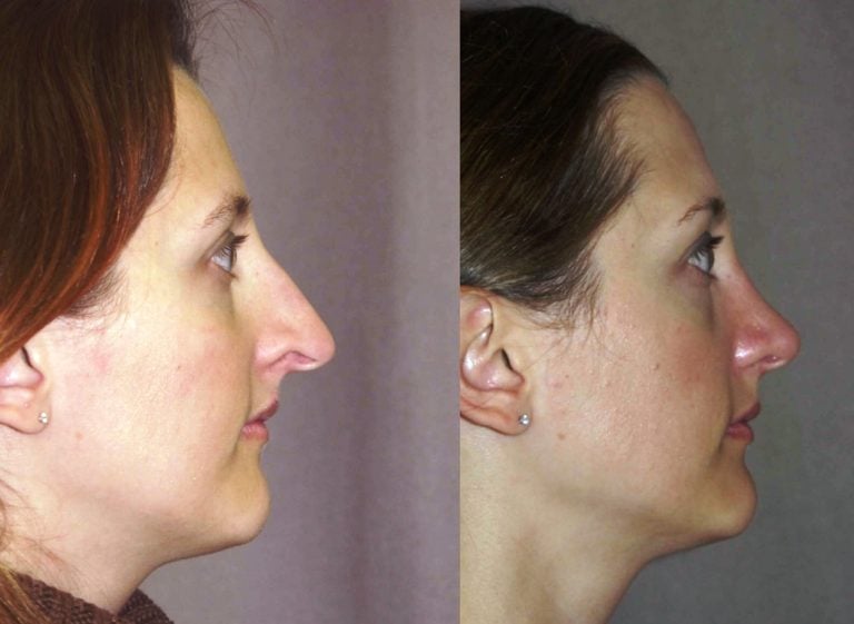 Rhinoplasty, internal graft to nostril rim, side
