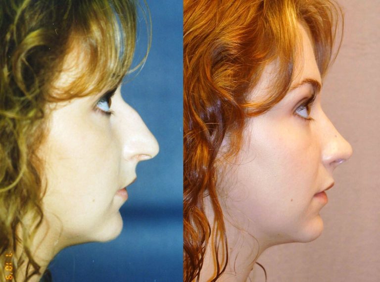 Nose lateral
