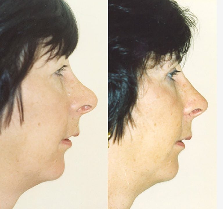 secondary rhinoplasty, correction of previous surgery