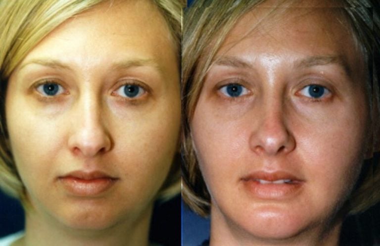 Patient 3 chin implant only