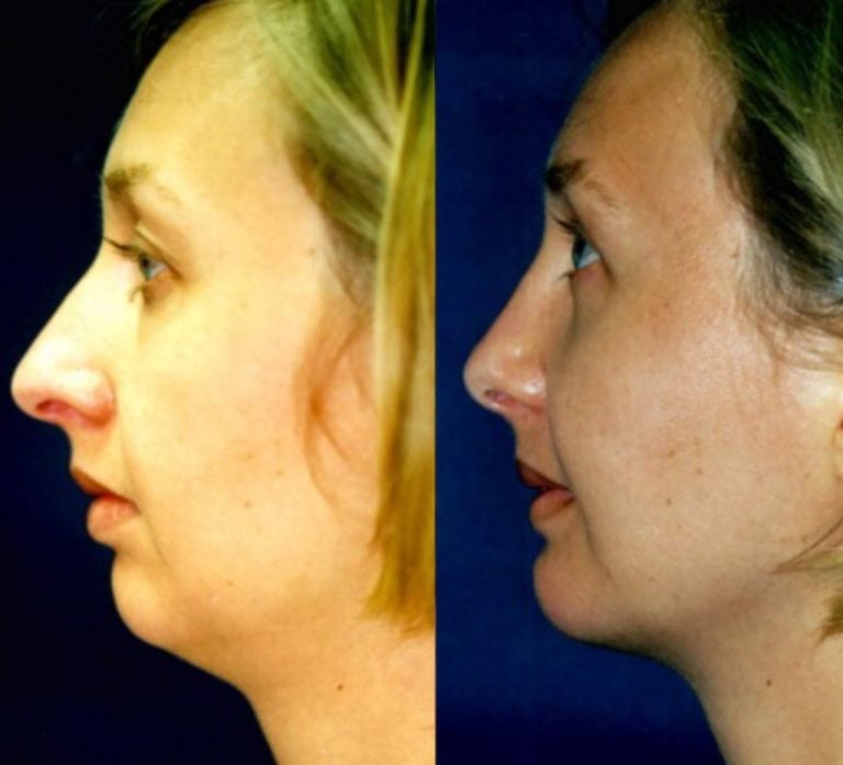 Patient 3 Chin implant rhinoplasty side