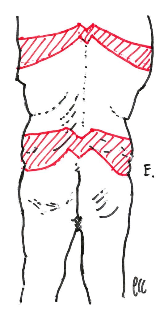 Posterior view lower and upper body lift