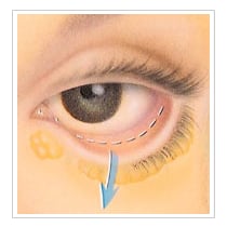 Procedure eyelift