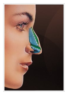 Procedure Rhinoplasty
