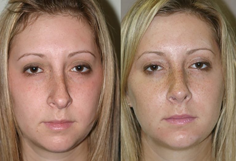 Revision-rhinoplasty-front