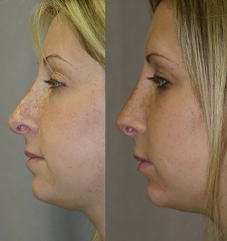 Revision Rhinoplasty - side