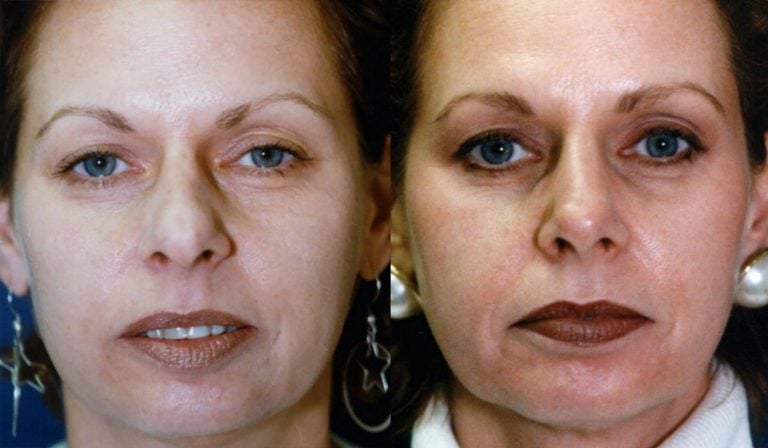 rhinoplasty