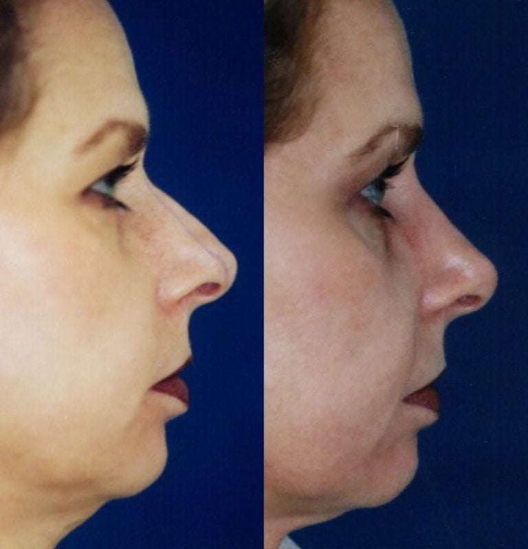 Rhinoplasty, side