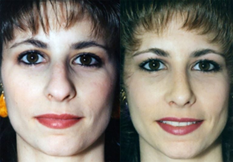 Rhinoplasty closed