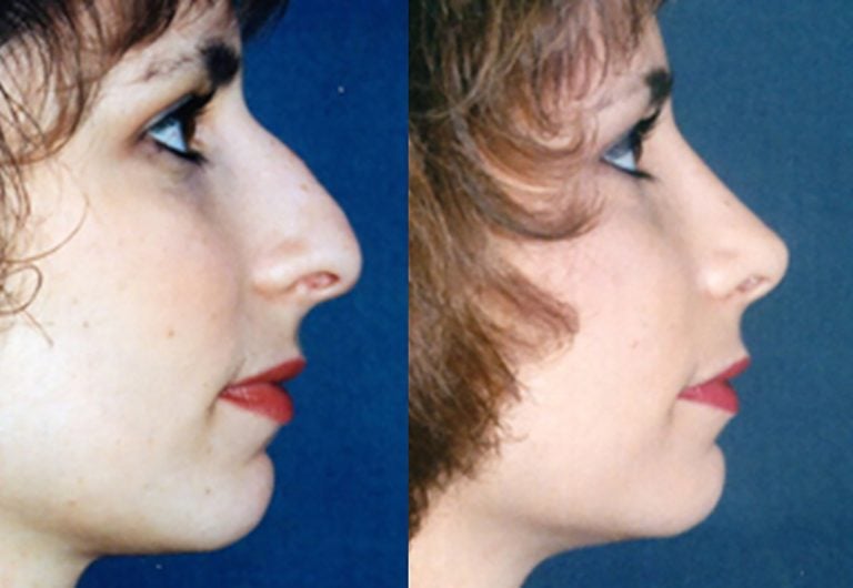 Rhinoplasty closed - side