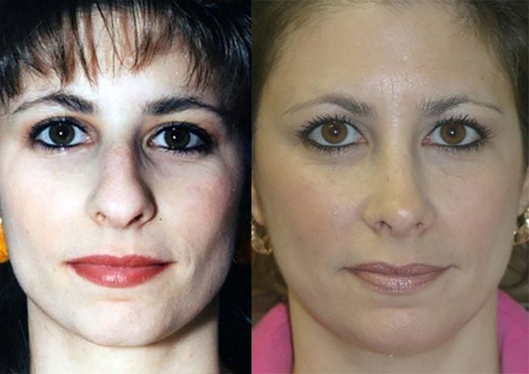 Rhinoplasty 11 year follow up