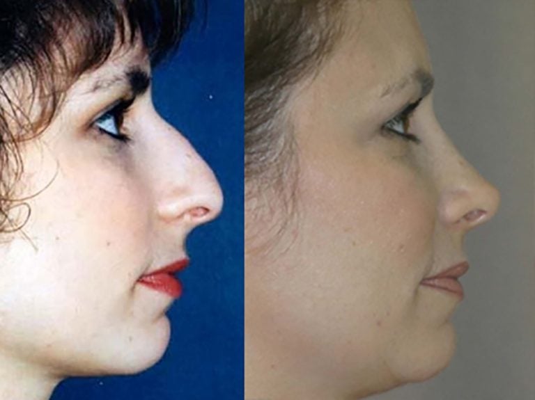 rhinoplasty-11-year-follow-up-side
