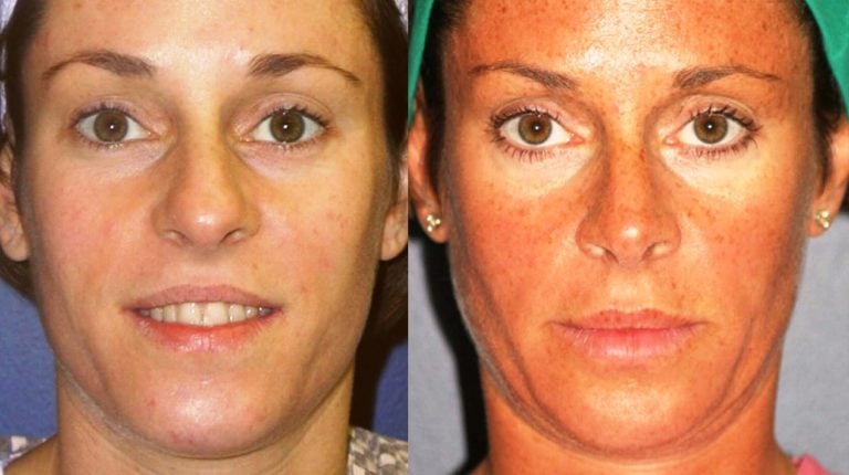 rhinoplasty 8 years front