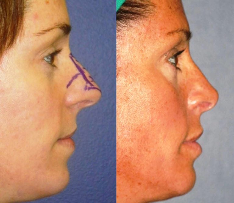 Rhinoplasty 8 years - side