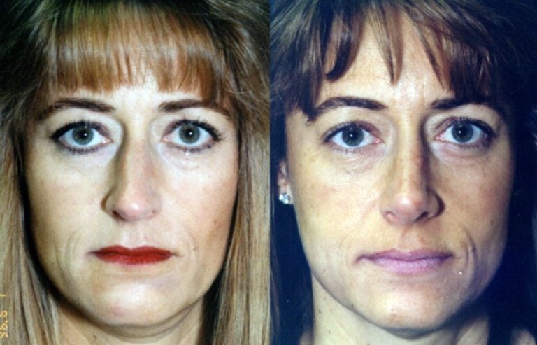 Rhinoplasty front