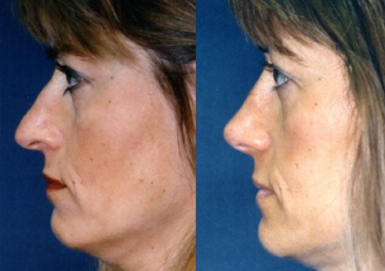 Rhinoplasty - side