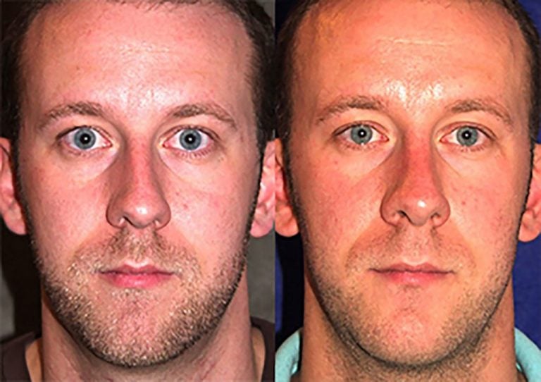 Rhinoplasty and chin implant one year after surgery