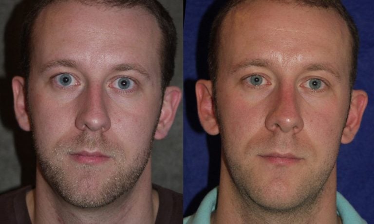 Rhinoplasty and chin implant one year after surgery, front view