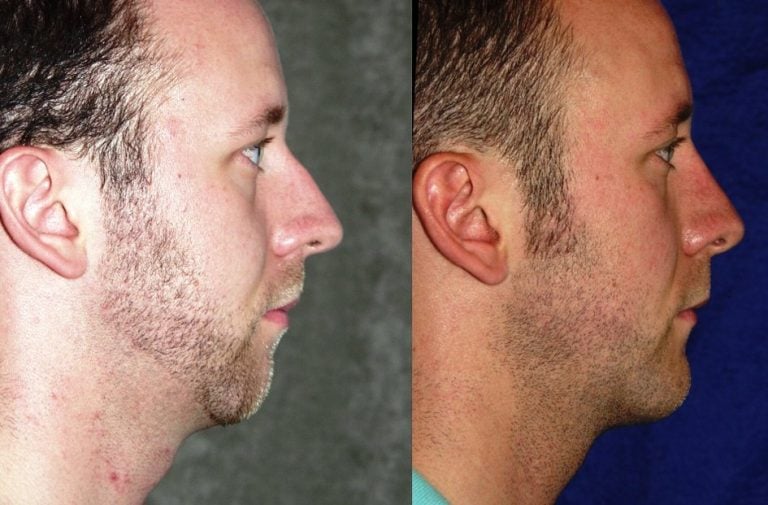 Rhinoplasty and chin implant one year after surgery profile