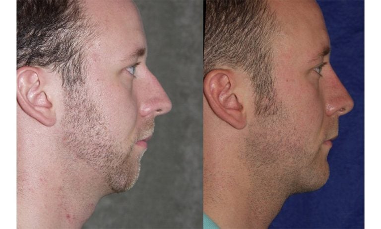 Rhinoplasty and chin implant one year after surgery side view