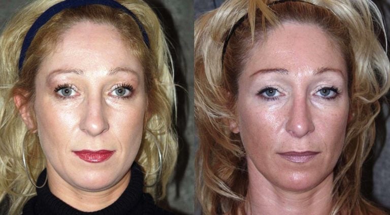 rhinoplasty-before-and-16-months-after-frontal-view