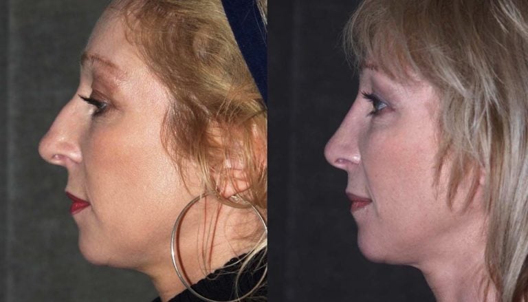 Rhinoplasty-before-and-16-months-after-side-view
