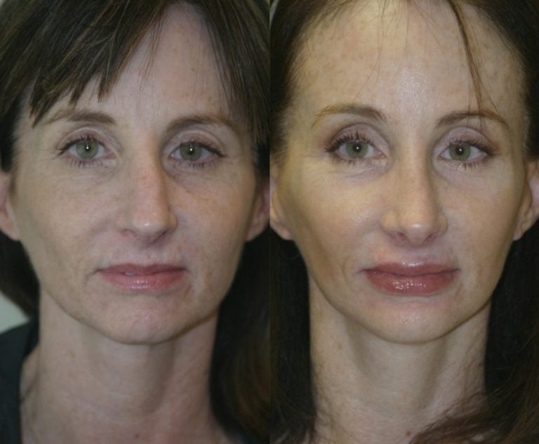 rhinoplasty-chin-implant-browlift-facelift